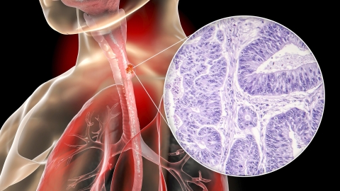 3D illustration of esophageal cancer